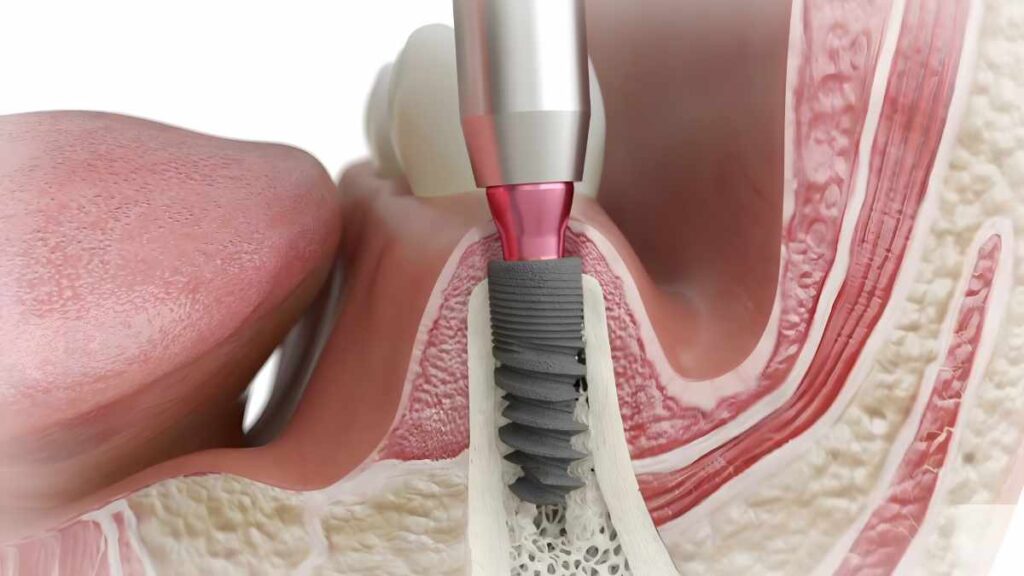 bone implant integration